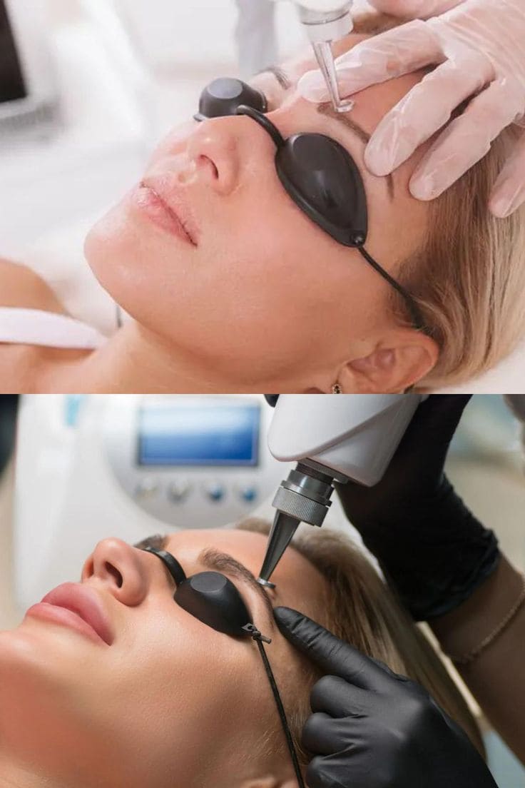 Trị Nám Bằng Laser: Ưu Điểm – Rủi Ro – Chi Phí Tham Khảo